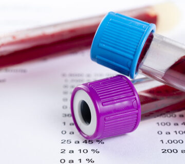 Analisi Colesterolo - Dott. Antonino Girone Nutrizionista