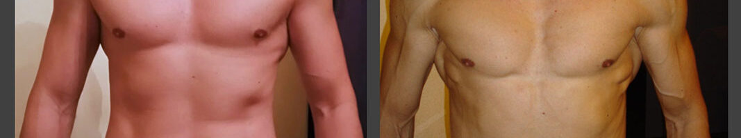 Aumento Massa Muscolare - Dott. Antonino Girone